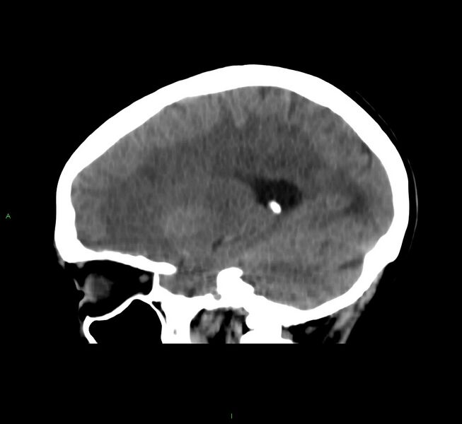 File:Cerebral amyloid angiopathy-associated lobar intracerebral hemorrhage (Radiopaedia 58566-65730 C 33).jpg