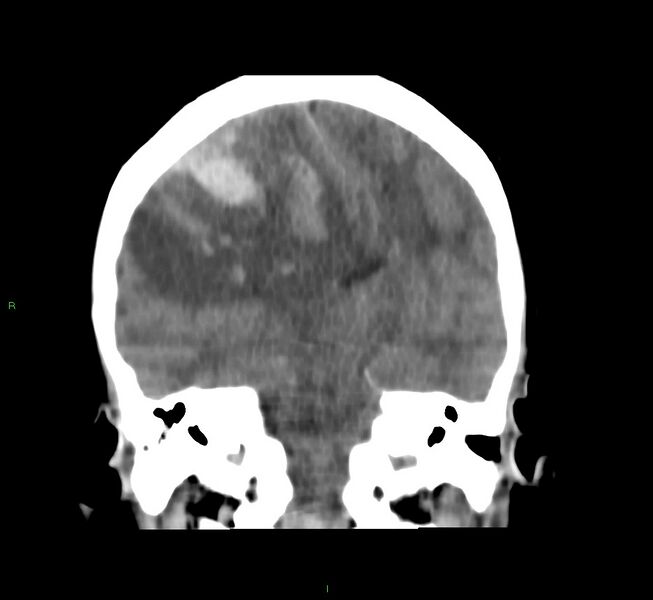 File:Cerebral amyloid angiopathy-associated lobar intracerebral hemorrhage (Radiopaedia 58751-65972 Coronal non-contrast 31).jpg