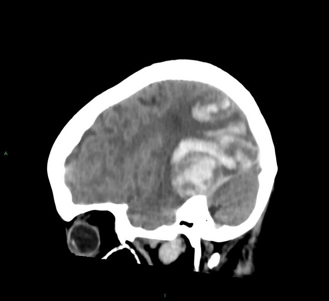 File:Cerebral amyloid angiopathy-associated lobar intracerebral hemorrhage (Radiopaedia 58754-65975 C 36).jpg