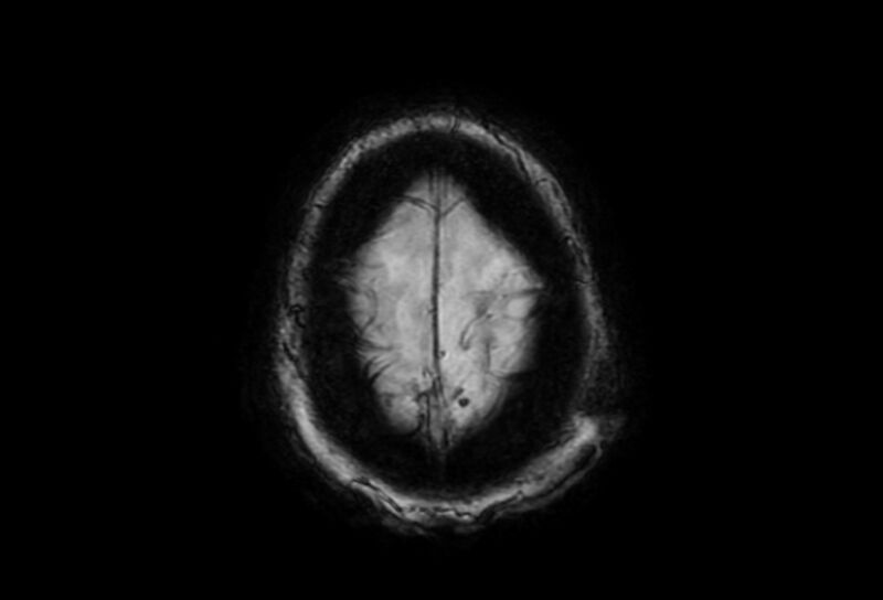 File:Cerebral amyloid angiopathy (Radiopaedia 86671-102792 Axial Gradient Echo 3).jpg