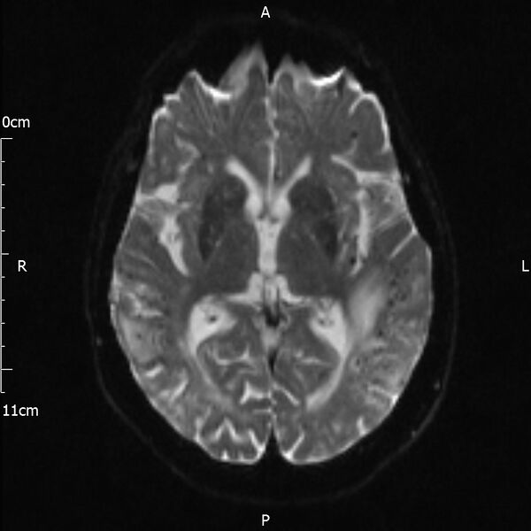 File:Cerebral amyloid angiopathy related inflammation (Radiopaedia 72772-83415 Axial DWI 12).jpg