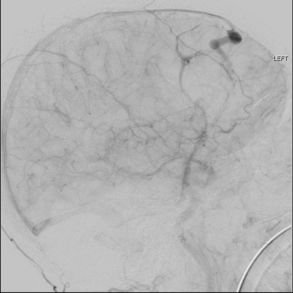 File:Cerebral arteriovenous malformation with lobar hemorrhage (Radiopaedia 44725-48513 LT CCA IC 39).png