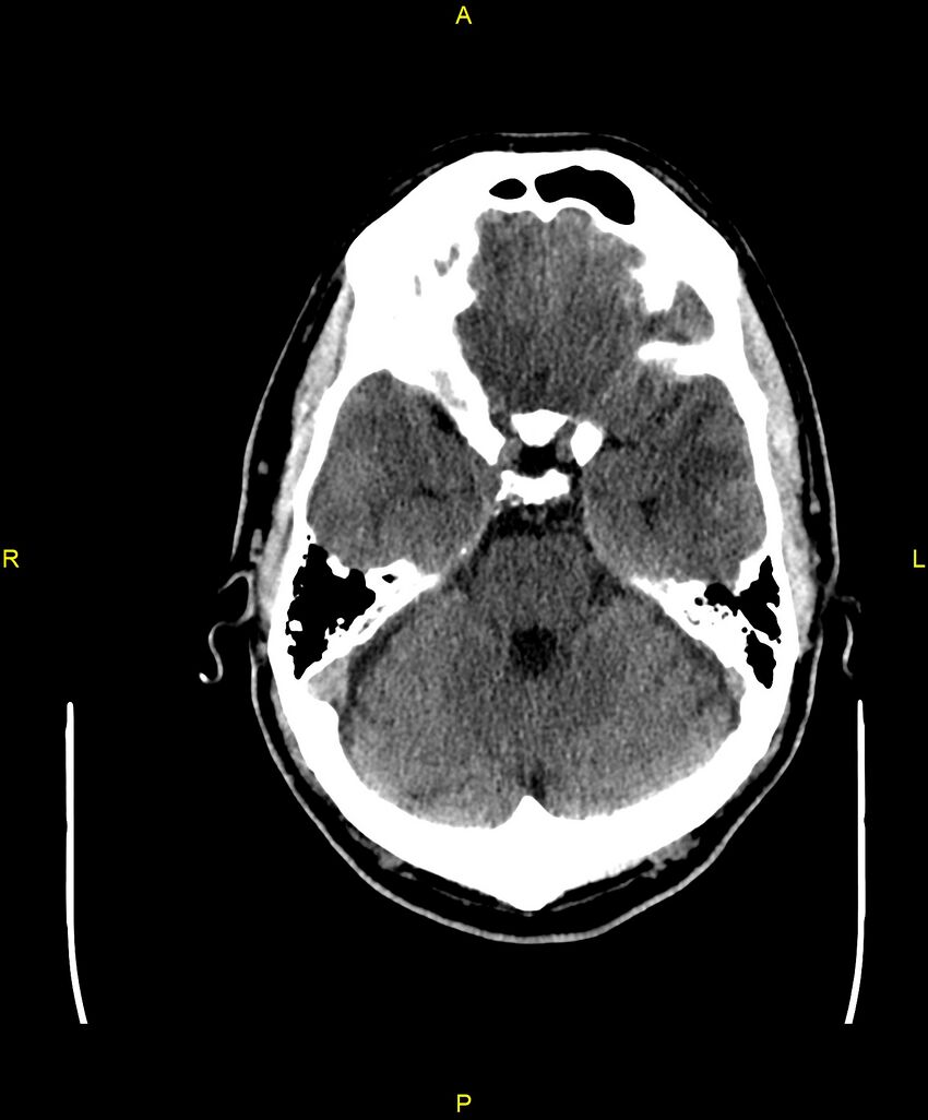 Cerebral autosomal dominant arteriopathy with subcortical infarcts and leukoencephalopathy (CADASIL) (Radiopaedia 86108-102051 Axial non-contrast 32).jpg
