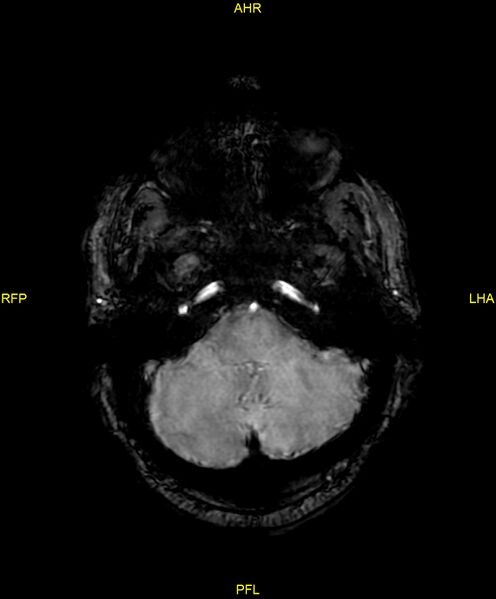 File:Cerebral autosomal dominant arteriopathy with subcortical infarcts and leukoencephalopathy (CADASIL) (Radiopaedia 86108-102054 Axial SWI 25).jpg