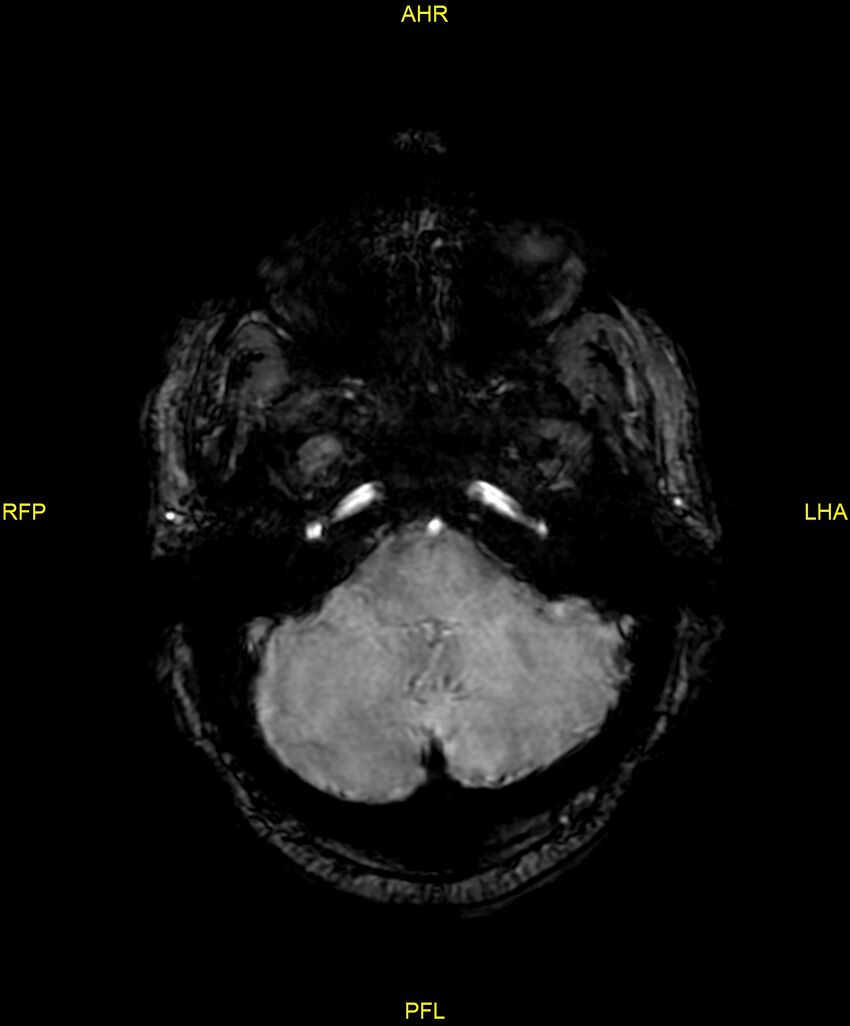 Cerebral autosomal dominant arteriopathy with subcortical infarcts and leukoencephalopathy (CADASIL) (Radiopaedia 86108-102054 Axial SWI 25).jpg