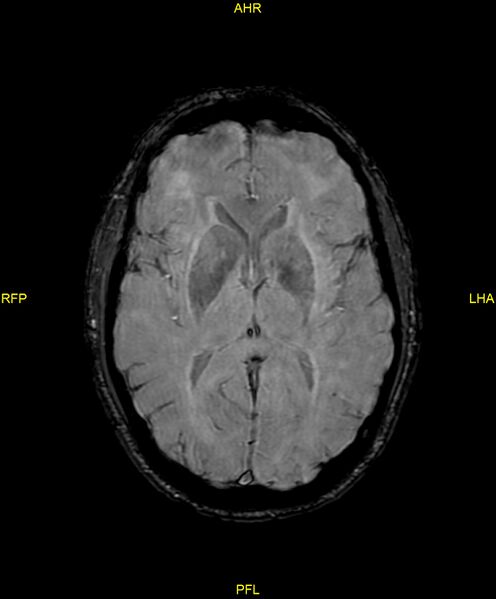 File:Cerebral autosomal dominant arteriopathy with subcortical infarcts and leukoencephalopathy (CADASIL) (Radiopaedia 86108-102054 Axial SWI 58).jpg