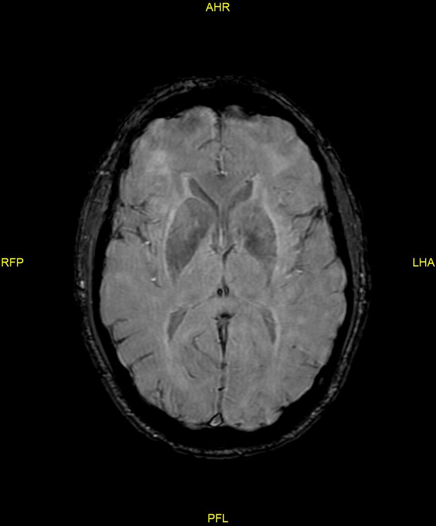 Cerebral autosomal dominant arteriopathy with subcortical infarcts and leukoencephalopathy (CADASIL) (Radiopaedia 86108-102054 Axial SWI 58).jpg