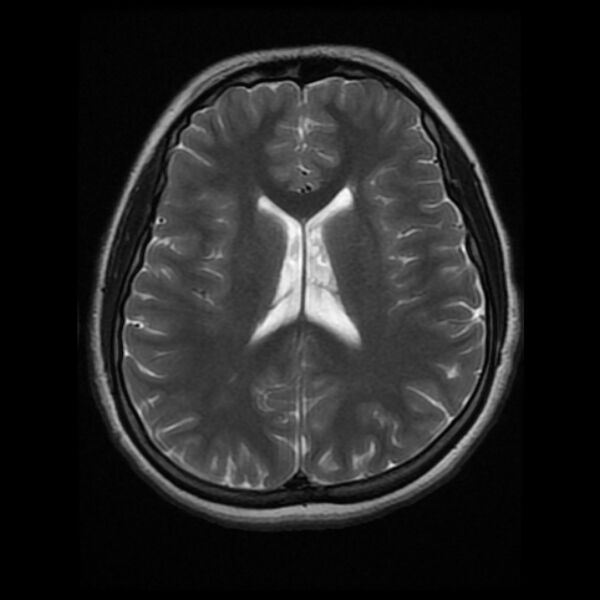 File:Cerebral cavernous malformation (Radiopaedia 44301-47942 Axial T2 13).jpg