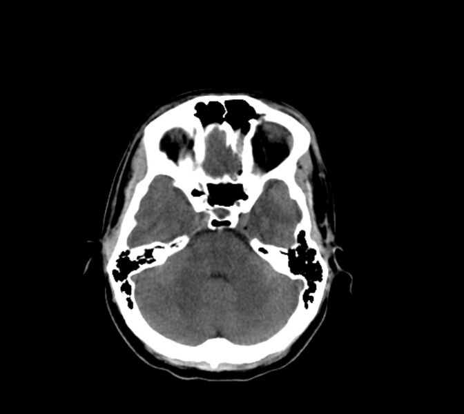 File:Cerebral fat embolism (Radiopaedia 37510-39362 Axial non-contrast 11).jpg