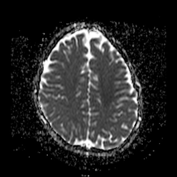 File:Cerebral tuberculoma (Radiopaedia 41152-43932 Axial ADC 17).jpg