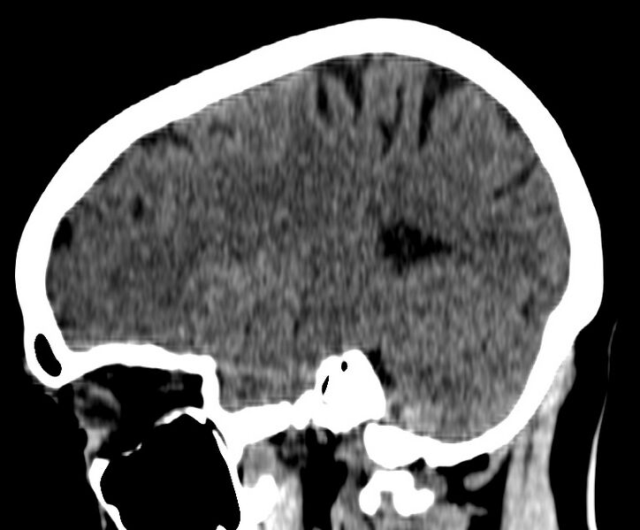 File:Cerebral venous thrombosis - CT only (Radiopaedia 41031-43778 B 9).jpg