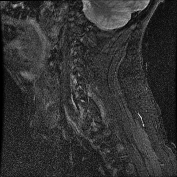 File:Cervical fracture and dislocation with locked facet (Radiopaedia 31837-32781 Sagittal STIR 2).jpg
