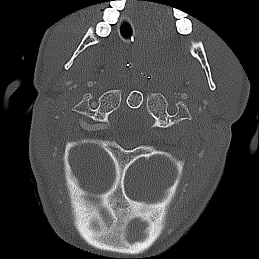Cervical spine fractures with vertebral artery dissection (Radiopaedia 32135-33078 Axial bone window 67).jpg