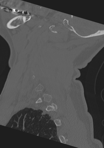 File:Cervical spine fractures with vertebral artery dissection (Radiopaedia 53296-59268 Sagittal bone window 57).png