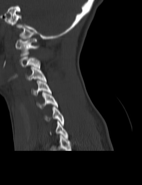 File:Cervical spine posterior ligamentous complex rupture (Radiopaedia 63486-72101 Sagittal bone window 4).jpg