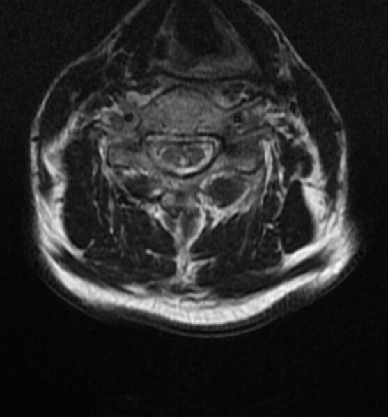 File:Cervical spondylodiscitis (Radiopaedia 81362-95110 Axial T2 10).jpg