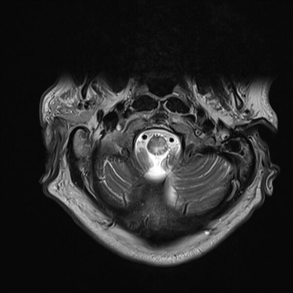 File:Cervical tumor-like myelopathy due to Type V dAVF (Radiopaedia 82461-96604 Axial T2 2).jpg