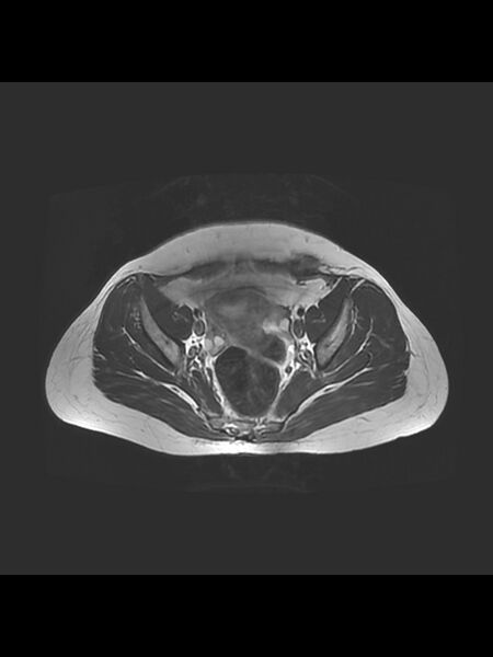 File:Cesarean section scar endometrioma (Radiopaedia 56569-63297 Axial T2 12).jpg