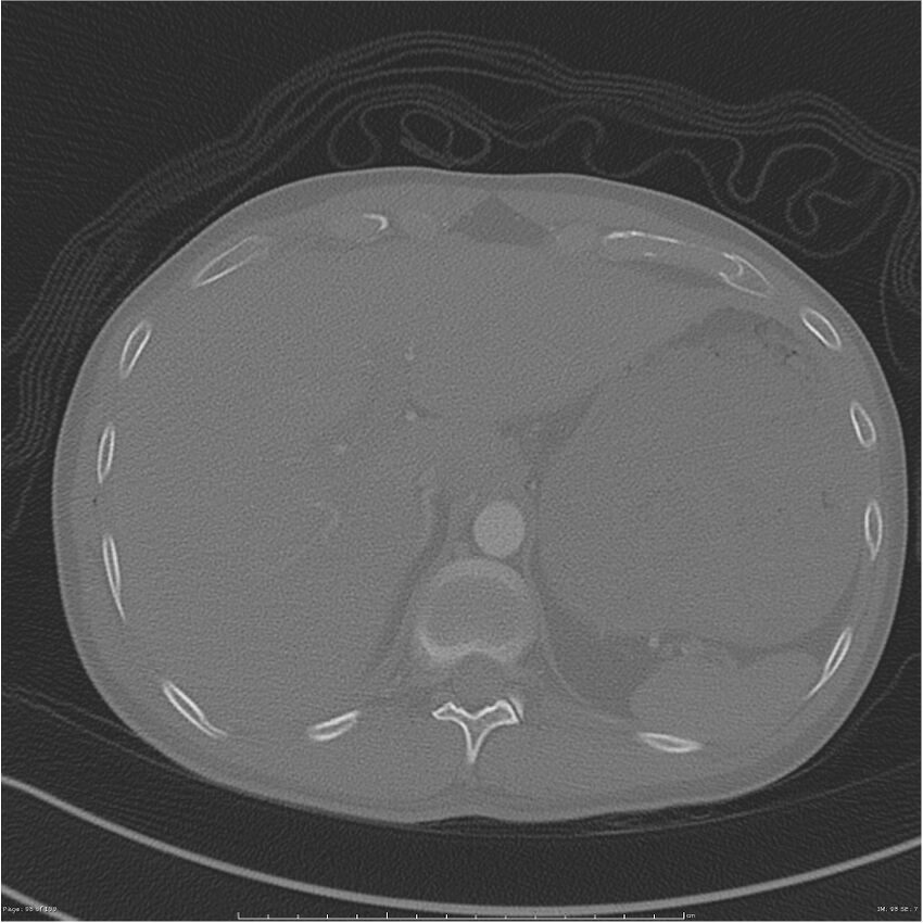 Chest and abdomen multi-trauma (Radiopaedia 26294-26425 bone window 98).jpg