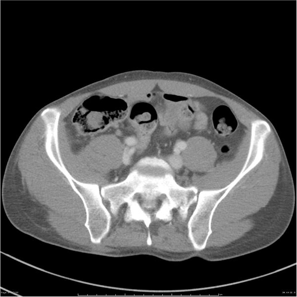 File:Chest and abdomen multi-trauma (Radiopaedia 26294-26426 A 64).jpg