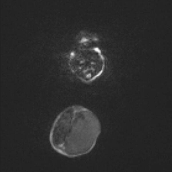 File:Chiari III malformation with occipital encephalocele (Radiopaedia 79446-92559 Axial DWI 24).jpg