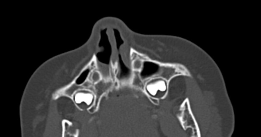 Choanal atresia (Radiopaedia 51295-56972 Axial bone window 9).jpg
