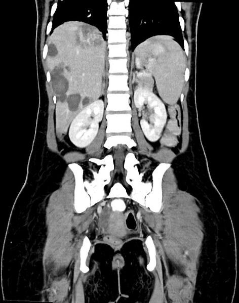 File:Choriocarcinoma liver metastases (Radiopaedia 74768-85766 B 69).jpg