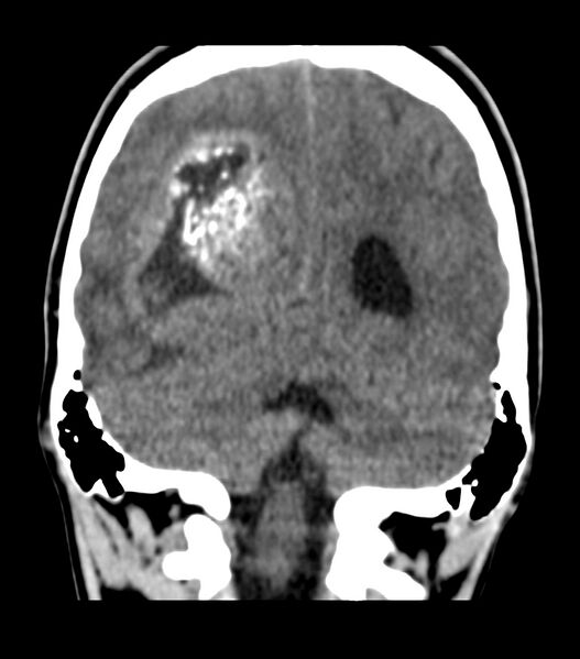 File:Choroid plexus carcinoma (Radiopaedia 91013-108552 Coronal non-contrast 62).jpg