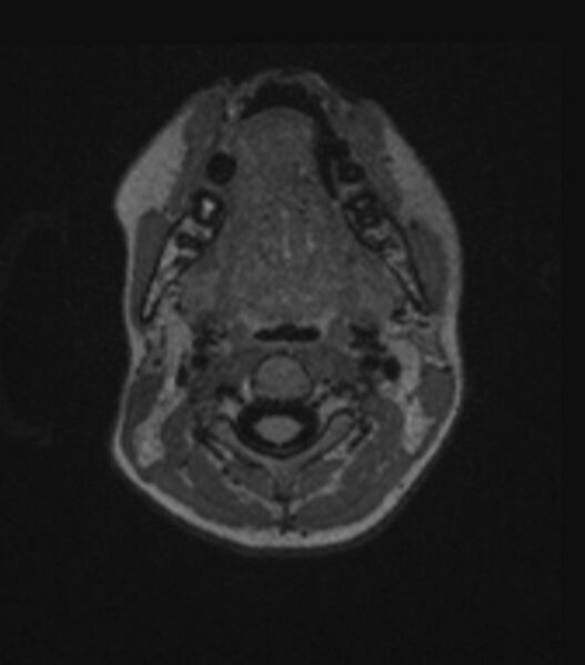 File:Choroid plexus carcinoma (Radiopaedia 91013-108553 Axial FLAIR C+ 36).jpg