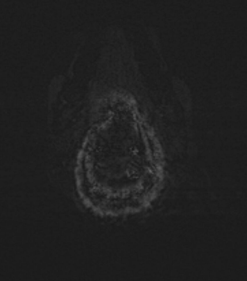 Choroid plexus carcinoma (Radiopaedia 91013-108553 Axial SWI 95).jpg
