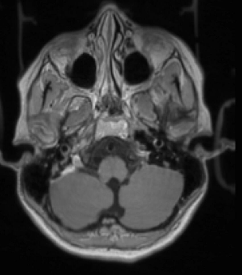 Choroid plexus carcinoma (Radiopaedia 91013-108553 Axial T1 C+ 87).jpg