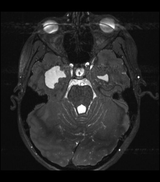 File:Choroid plexus carcinoma (Radiopaedia 91013-108553 Axial T2 CISS 5).jpg