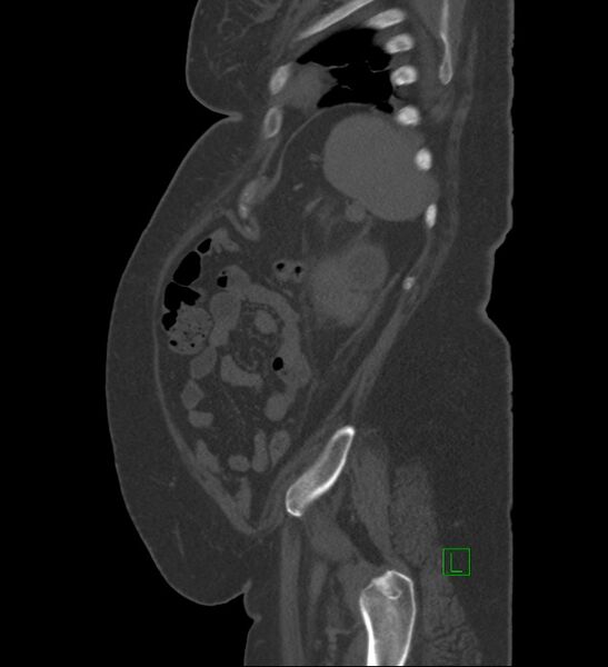 File:Chromophobe renal cell carcinoma (Radiopaedia 84239-99519 Sagittal bone window 17).jpg