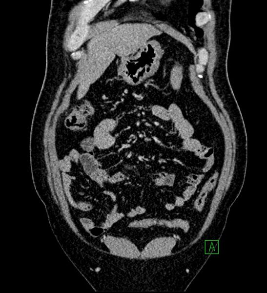 File:Chromophobe renal cell carcinoma (Radiopaedia 84286-99573 H 42).jpg