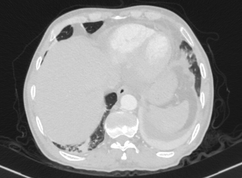 File:Chronic pulmonary embolism with bubbly consolidation (Radiopaedia 91248-108850 Axial lung window 130).jpg