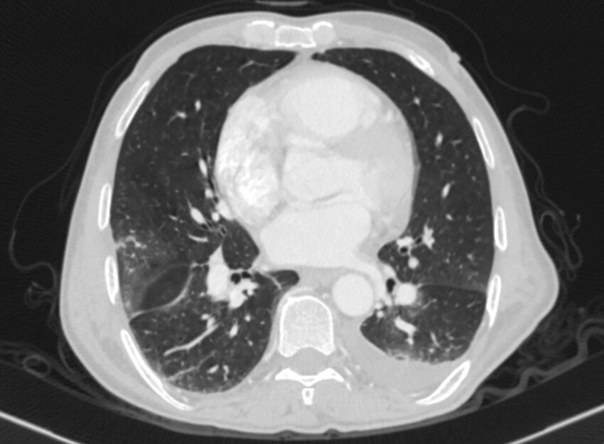 Chronic pulmonary embolism with bubbly consolidation (Radiopaedia 91248-108850 Axial lung window 95).jpg