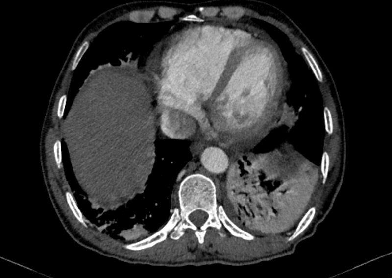 File:Chronic pulmonary embolism with bubbly consolidation (Radiopaedia 91248-108850 C+ arterial phase 117).jpg