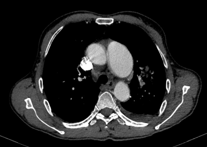 File:Chronic pulmonary embolism with bubbly consolidation (Radiopaedia 91248-108850 C+ arterial phase 48).jpg