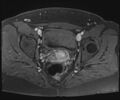 Class II Mullerian duct anomaly- unicornuate uterus with rudimentary horn and non-communicating cavity (Radiopaedia 39441-41755 Axial T1 fat sat 85).jpg