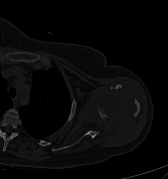 File:Clear cell chondrosarcoma - humerus (Radiopaedia 63104-71612 Axial bone window 47).jpg