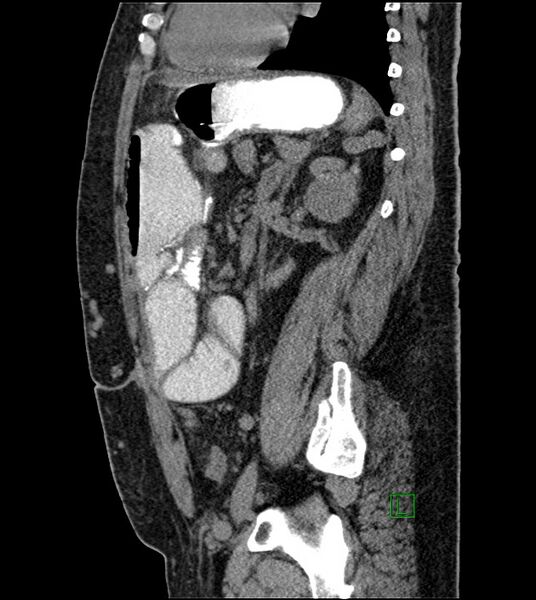 File:Closed-loop small bowel obstruction-internal hernia (Radiopaedia 78439-91096 C 59).jpg