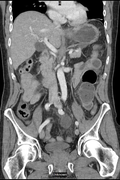 File:Closed loop bowel obstruction and ischemia (Radiopaedia 86959-103180 B 20).jpg