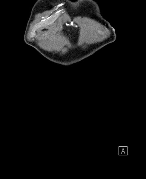 File:Closed loop small bowel obstruction - internal hernia (Radiopaedia 57806-64778 A 2).jpg