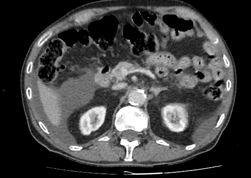 File:Closed loop small bowel obstruction with ischemia (Radiopaedia 84180-99456 A 36).jpg
