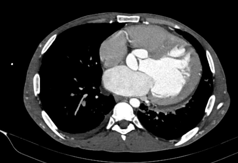 File:Coarctation of aorta with aortic valve stenosis (Radiopaedia 70463-80574 A 132).jpg