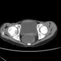 Colocolic fistula - Crohn disease (Radiopaedia 57063-63955 A 86).jpg