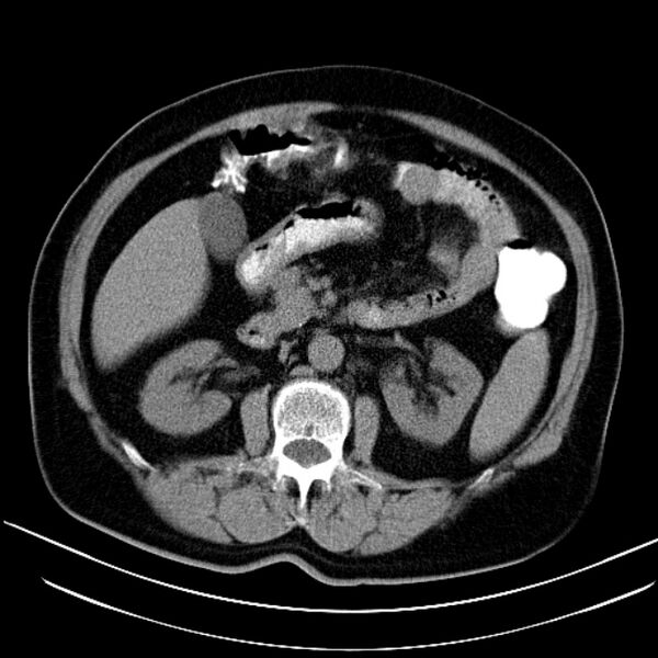 File:Colon adenocarcinoma (Radiopaedia 15157-15025 Axial non-contrast 4).jpg
