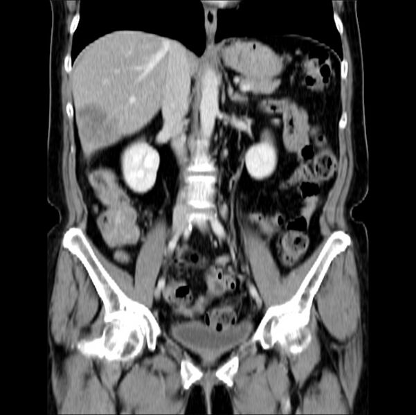 File:Colon carcinoma with hepatic metastases (Radiopaedia 29477-29961 B 23).jpg