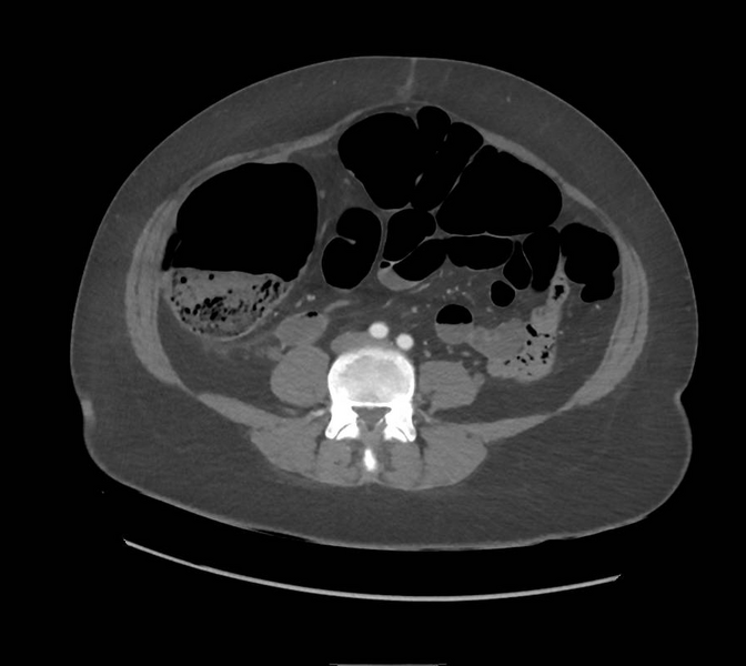 File:Colonic pseudo-obstruction (Radiopaedia 79752-92980 A 114).png