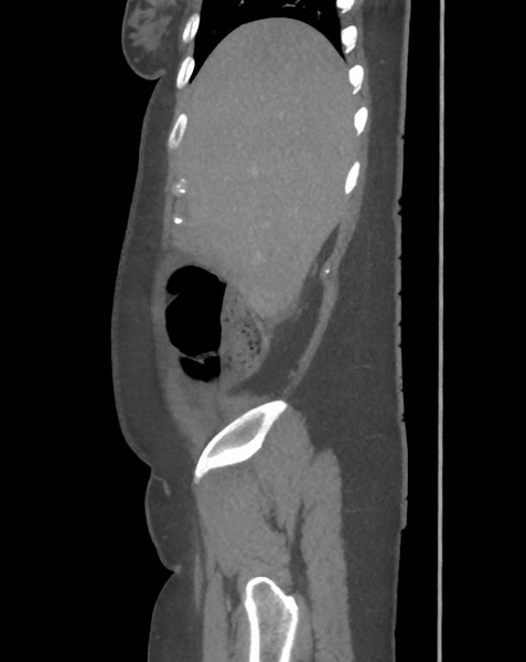 File:Colonic pseudo-obstruction (Radiopaedia 79752-92980 C 16).png